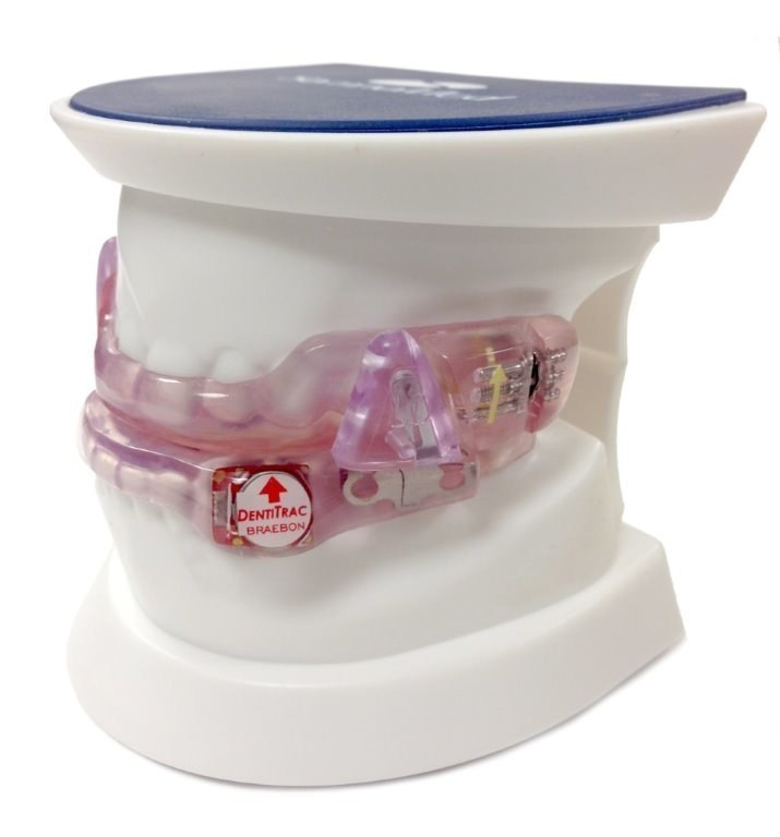 Braebon's DentiTrac&circledR; is an integrated wearable micro-recorder and web cloud portal combination for the objective measurement of oral appliance compliance measurement for sleep apnea.