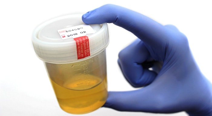 Aggressive cancer in prostate, New urine test for prostate cancer